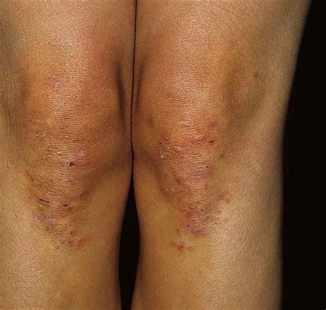 Best Dermatitis Herpetiformis Images In Dermatitis My Xxx Hot Girl