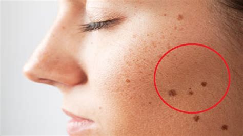 how to get rid of beauty marks fast youtube