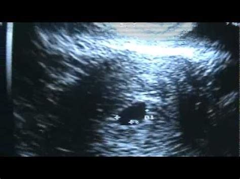This is our 3rd pregnancy. Our little miracle: Ultrasound at 5 weeks 3 days gestation ...