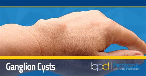 Ganglion Cyst Wrist Causes