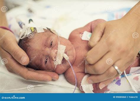Bebé Prematuro Recién Nacido En Los Cuidados Intensivos De Nicu Foto De
