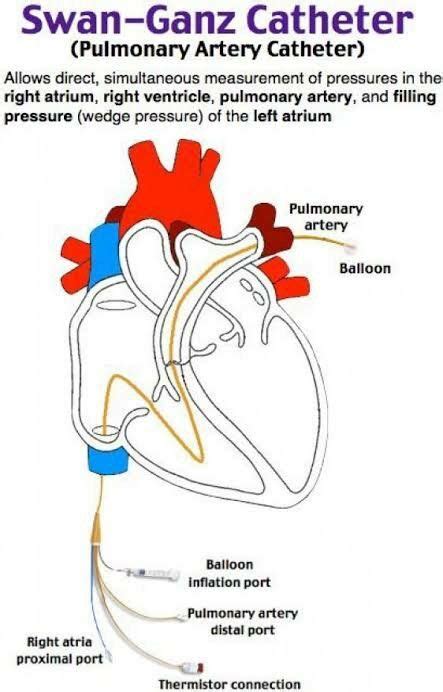 Pulmonary Artery Catheter Indication And Uses Nurses Note Link 👇 In
