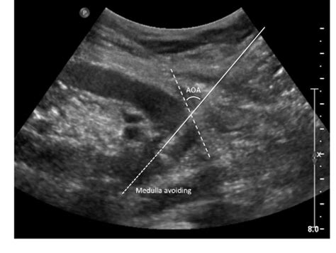 Direction Of The Biopsy Needle In Ultrasound Guided Renal Biopsy