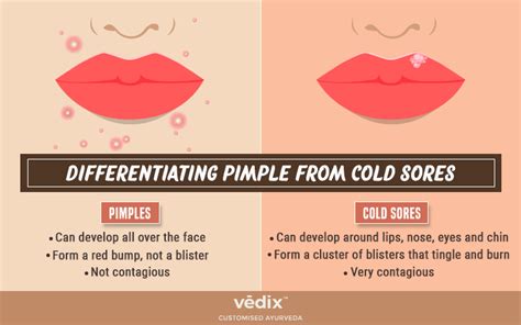 How To Identify Whether You Have A Pimple Or A Cold Sore Vedix