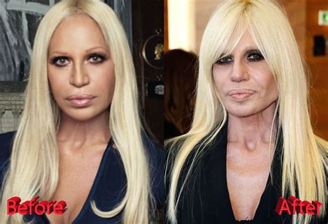 Donatella Versace Plastic Surgery Not Fashionable At All