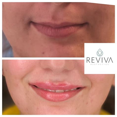 Juvéderm Lip Enhancement • Reviva Clinic