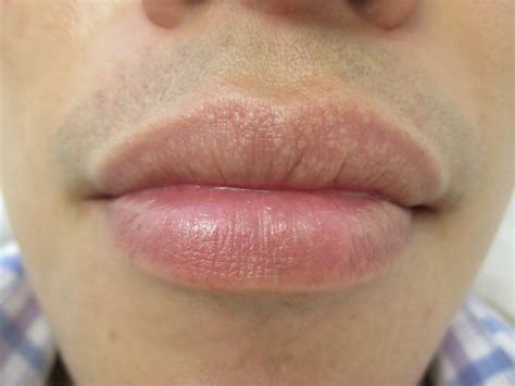 Kiss And Tell Variations Of Normal And Pathology Of The Lips With