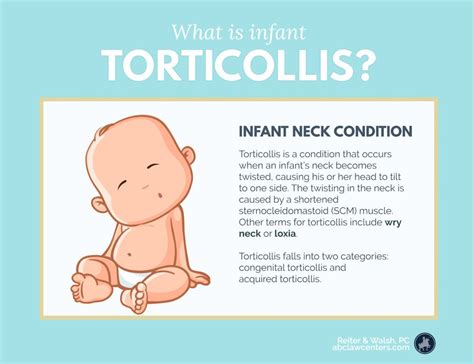 Learn About Torticollis Torticollis Pediatric Physical Therapy