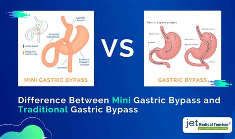 Mini Gastric Bypass Vs Gastric Bypass Gastric Bypass Gastric Bypass