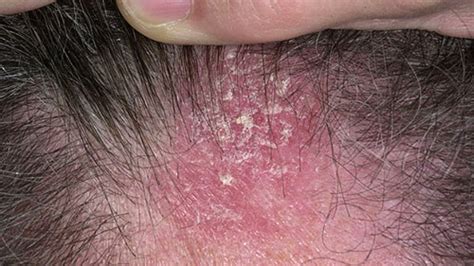 Discoid Lupus Scalp Pictures Photos