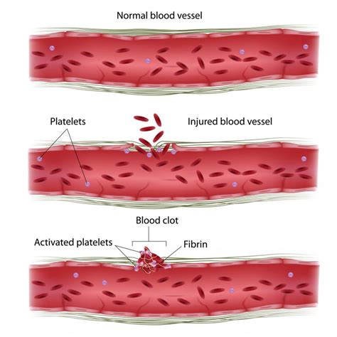 How Common Are Blood Clots During Pregnancy With Pictures