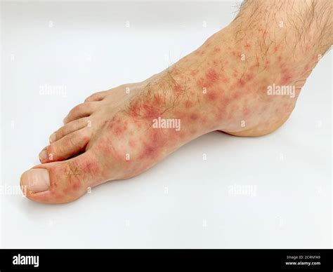 Close Up Of Males Foot And Toes With Red Rash Desease On A White