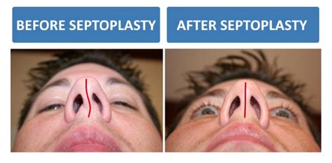 Types Of Deviated Septum Surgery Complete Guide To Septoplasty My Xxx