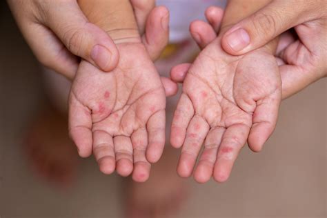 Hand Fuß Mund Krankheit Symptome Bei Kindern Und Erwachsenen