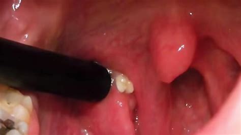 How To Remove Tonsil Stones At Home And Easy Way V 4 You Youtube