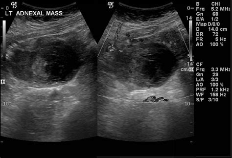 Adenomyosis With Endometrioma Radiology Case