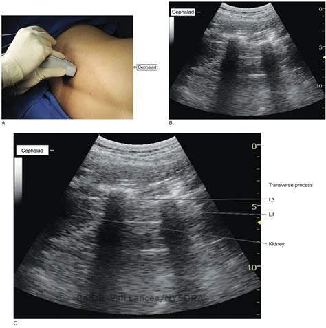 Sonography Of The Lumbar Paravertebral Space And Considerations For