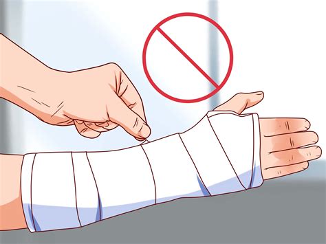 How To Take A Cast Off At Home - How to Apply a Cast to a Broken Arm: 14 Steps (with Pictures)