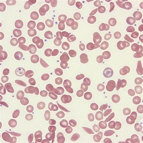 Sickle Cell Anemia Under Microscope Mamudoskitrautman