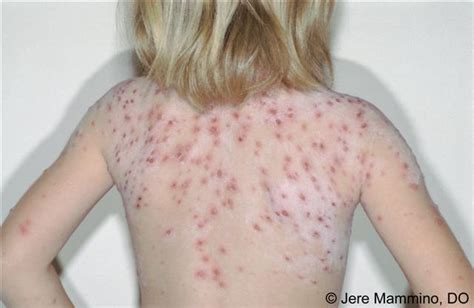 Chicken Pox - American Osteopathic College of Dermatology (AOCD)