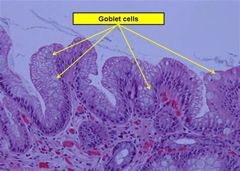 Barrett Esophagus Gastrointestinal Medbullets Step 1