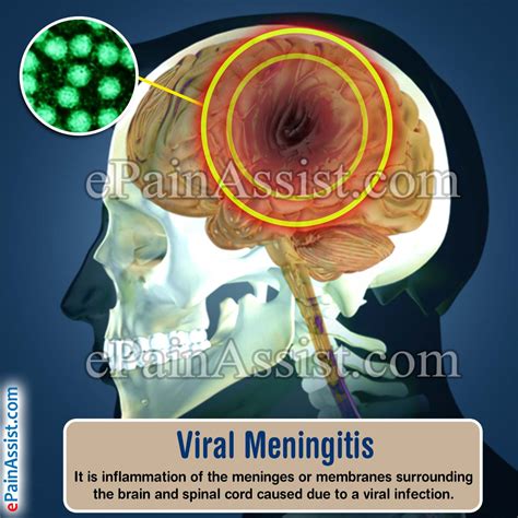 Viral Meningitis Treatment Prevention Symptoms Causes After Effects