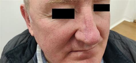 Bcc Right Nose Dr Vindy Ghura Dermatologist Manchester