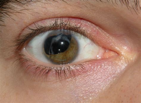 Natural Cure For Cataracts General Center
