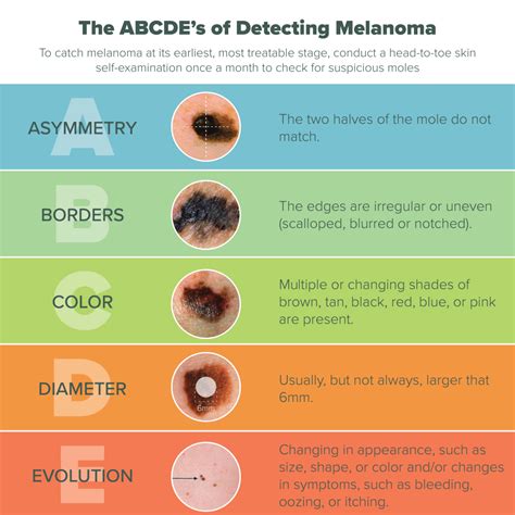 Melanoma Symptoms Abcde Detecting Skin Cancer Early Doctor Heck