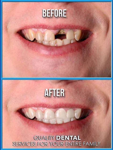 Dental Implants Pictures Before And After Photos Of Dental Implants