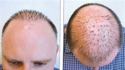 TopReviews-end: About 'hair implant'-Is Lidia Bastianich's hair getting