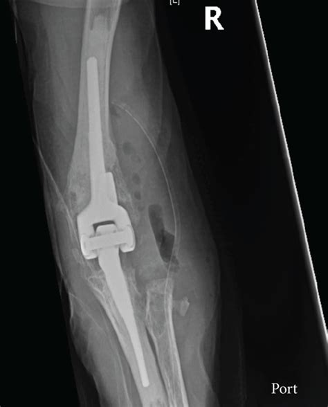 A Ap And B Lateral Radiographs Of R Elbow In Recovery Bay Following