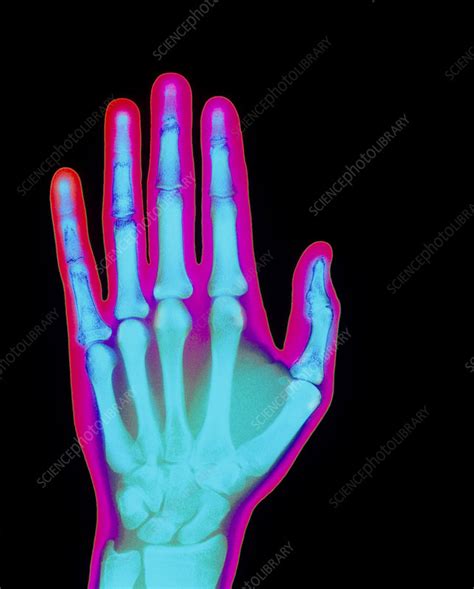 Coloured X Ray Of The Healthy Hand Of A Man Stock Image P1160276