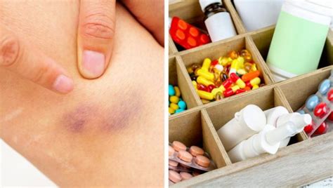 6 Health Problems That Can Cause Bruises On Your Body Women Daily