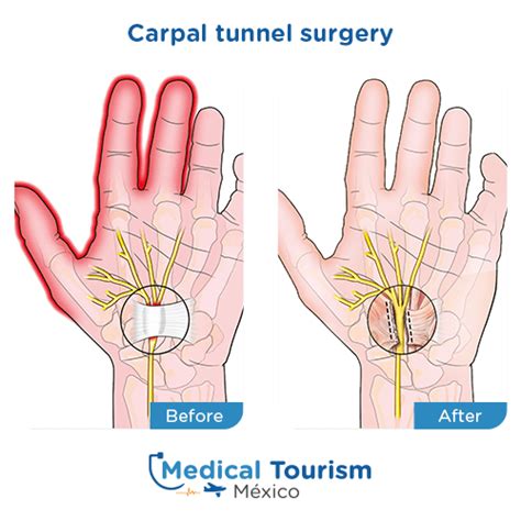 Best Neurosurgeons For Carpal Tunnel Surgery Medical Tourism Mexico