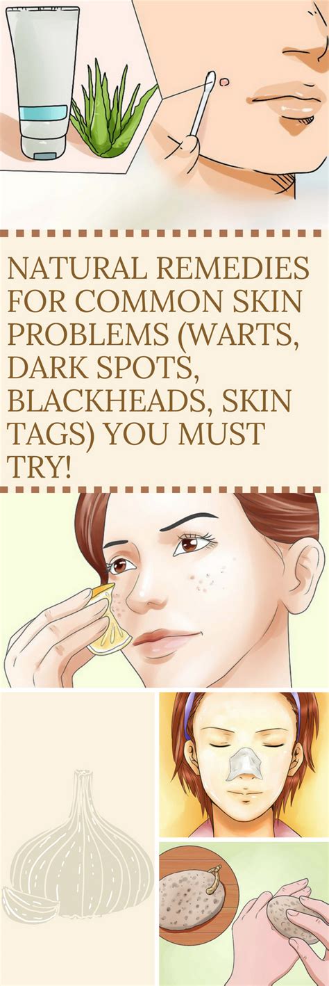 Natural Remedies For Common Skin Problems Warts Dark Spots