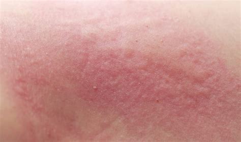 When To Worry About A Rash In Adults Healthella Page 8