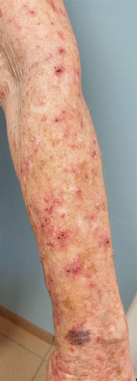 Inflammatory Changes In Actinic Keratoses Associated With Afatinib