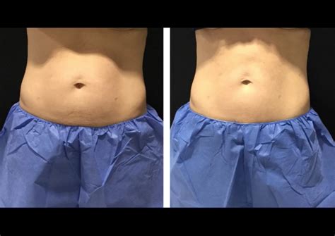 Coolsculpting Images Before And After Pictures Sculptcypress
