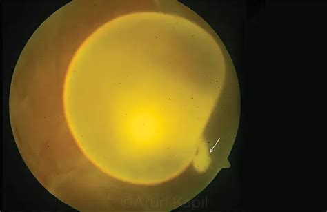 Intravitreal Cysticercosis With Exvaginated Scolex American Academy