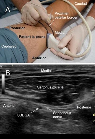 Ultrasound Guided Saphenous Nerve Block Within Versus Distal To The