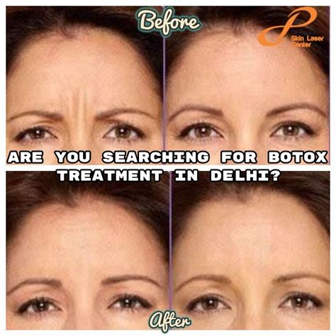 Botox Treatment In Delhi Botox How To Line Lips Laser Skin
