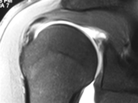 Mri Of Slap Type 2 Tear Arizona Institute For Sports Knees And Shoulders