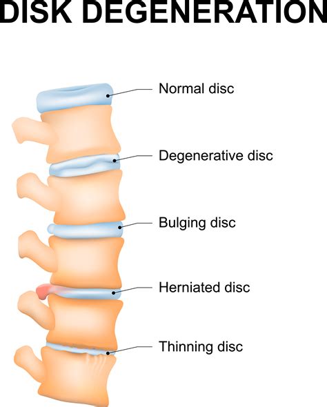 Degenerative Disc Disease DDD Causes Symptoms Treatments