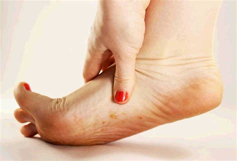 Athletes Foot Fungal Infection Causes Symptoms And Treatment Treating Fungus