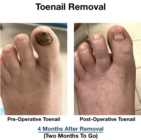 Toenail Removal Pictures