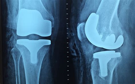 Protesis Total De Rodilla Ortopedia