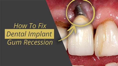 Fix Dental Implant Gum Recession Youtube