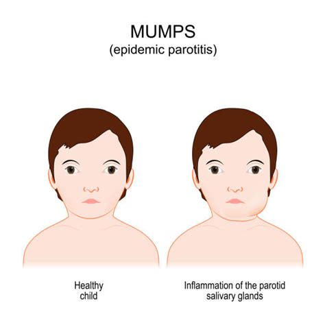 820 Mumps Stock Illustrations Royalty Free Vector Graphics And Clip Art