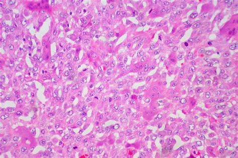 Giant Cell Neoplasm Of Subcutaneous Tissue Ed Uthman Flickr